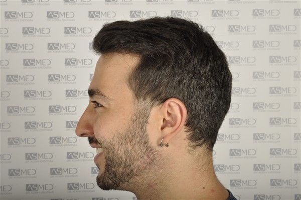 Before and After  graft    transplant at 