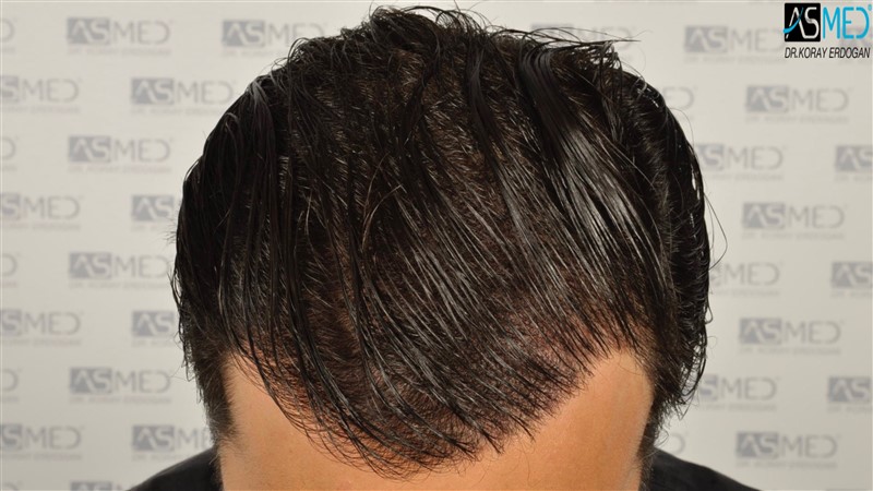 Before and After  graft    transplant at 