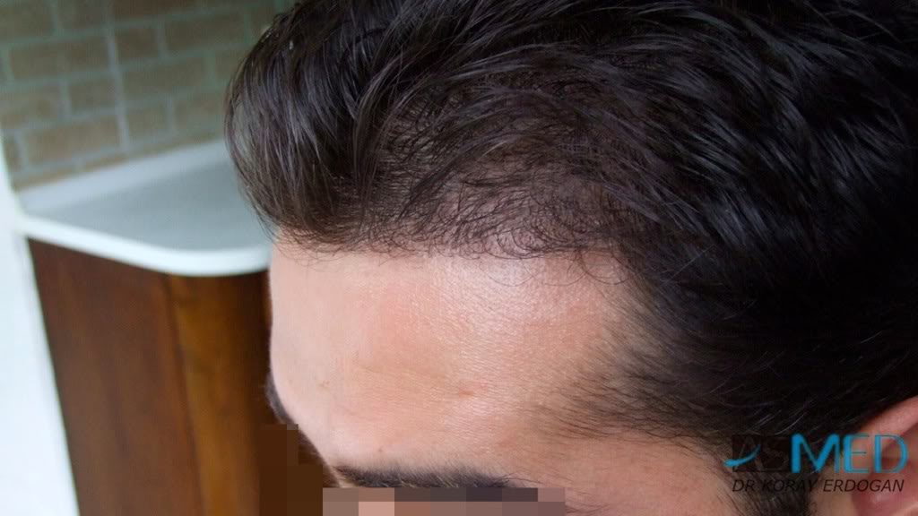 Before and After  graft    transplant at 