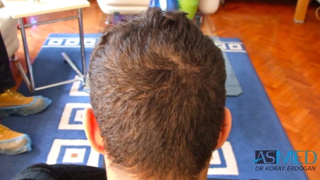 Before and After  graft    transplant at 