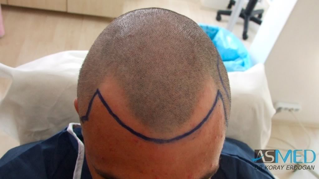 Before and After  graft    transplant at 