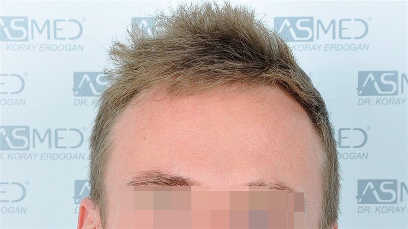 Before and After  graft    transplant at 