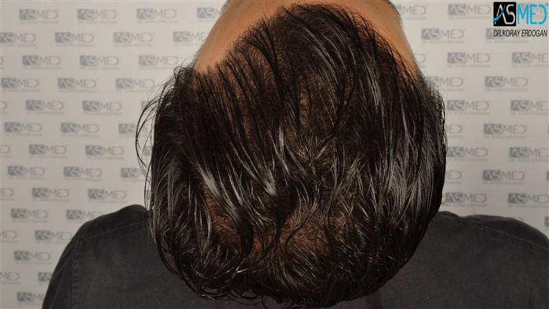 Before and After  graft    transplant at 