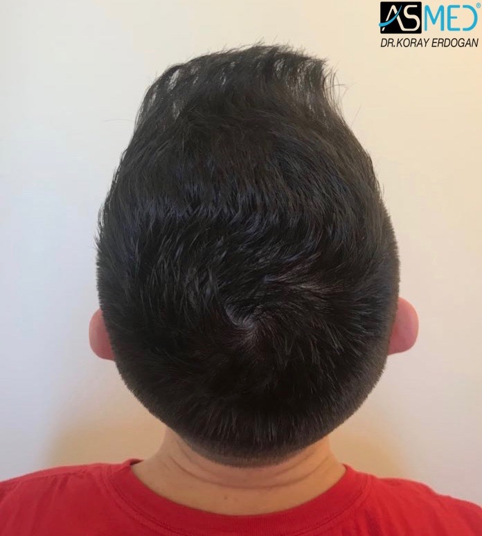 FUE Hair Transplant Result