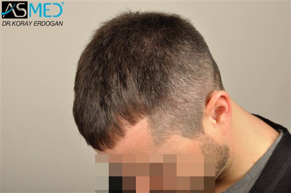 Before and After  graft    transplant at 