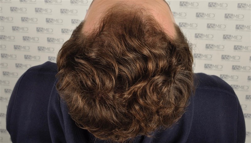 Before and After  graft    transplant at 