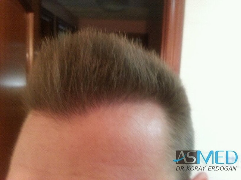 Before and After  graft    transplant at 