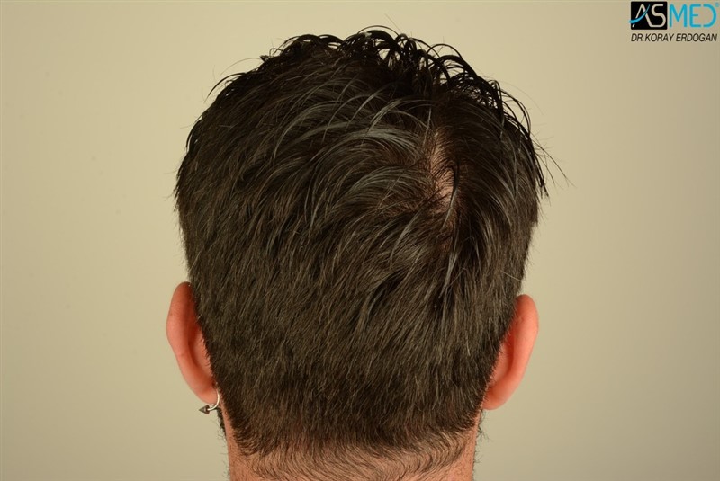Before and After  graft    transplant at 
