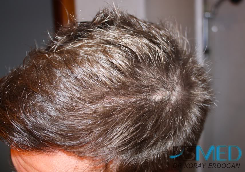 Before and After  graft    transplant at 