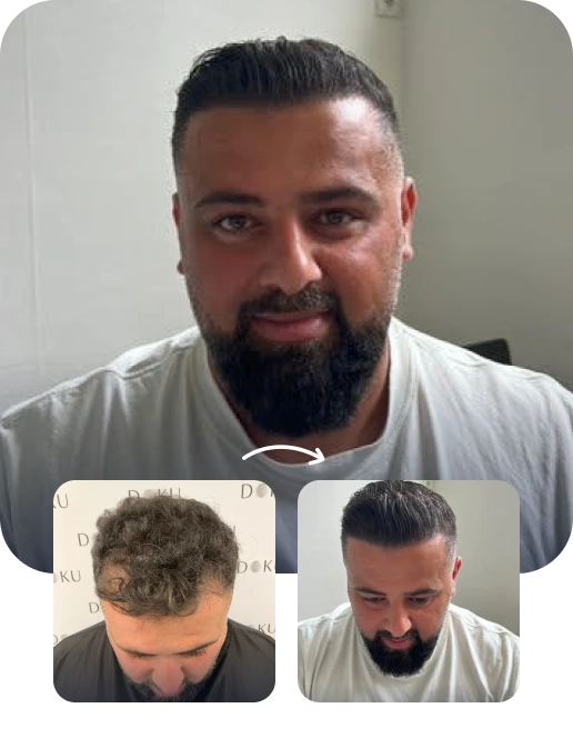 DHI Hair Transplant Result