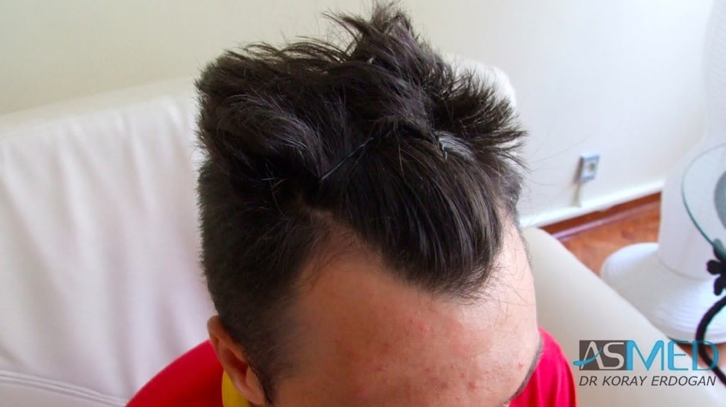 Before and After  graft    transplant at 
