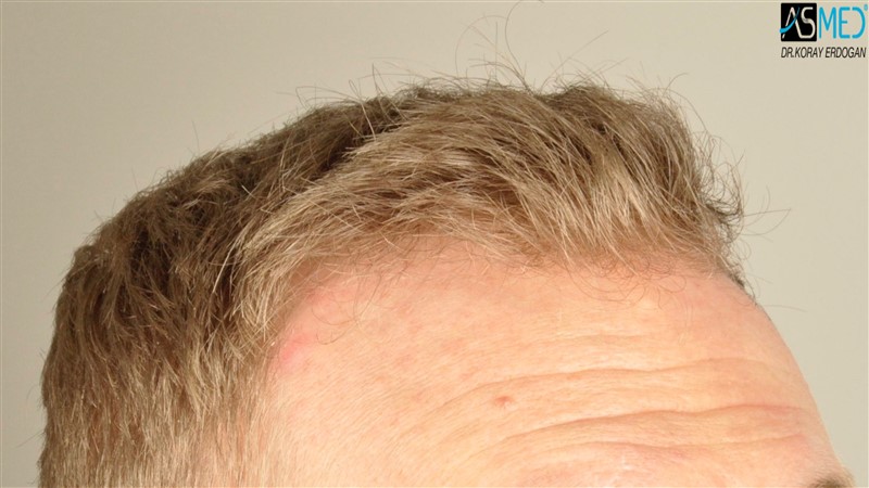 Before and After  graft    transplant at 