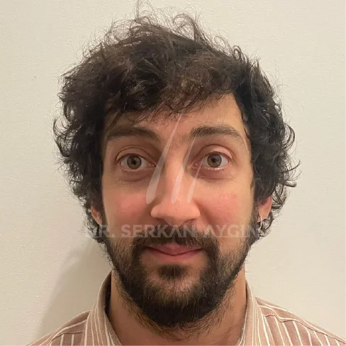 DHI Hair Transplant Result
