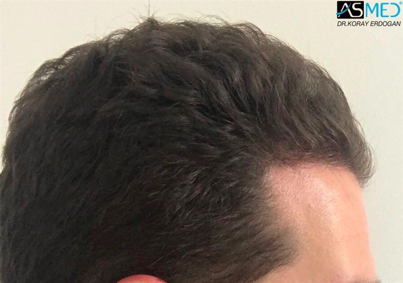 Before and After  graft    transplant at 