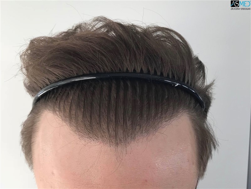 FUE Hair Transplant Result