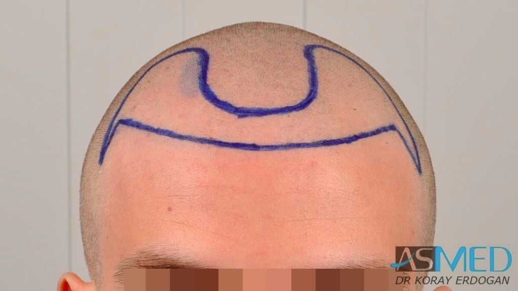 Before and After  graft    transplant at 