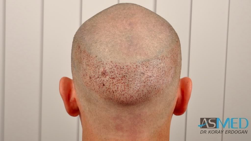 Before and After  graft    transplant at 