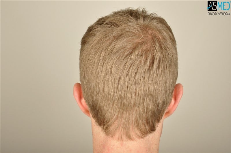 Before and After  graft    transplant at 