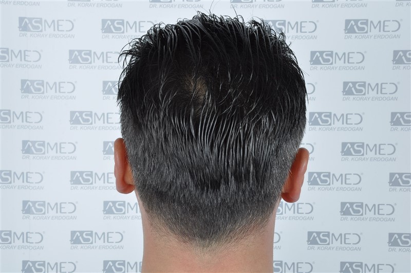 Before and After  graft    transplant at 
