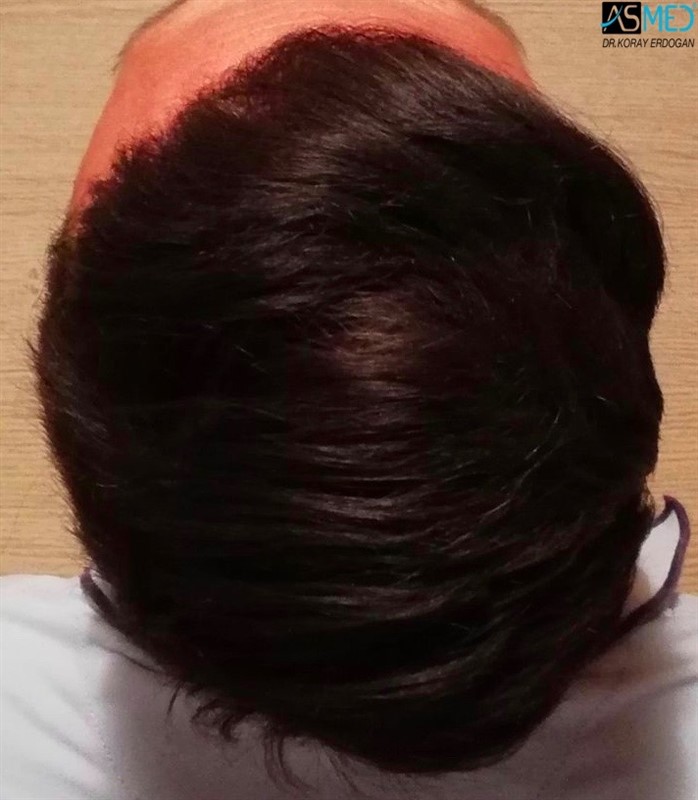 Before and After  graft    transplant at 