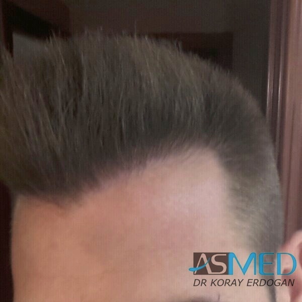 Before and After  graft    transplant at 