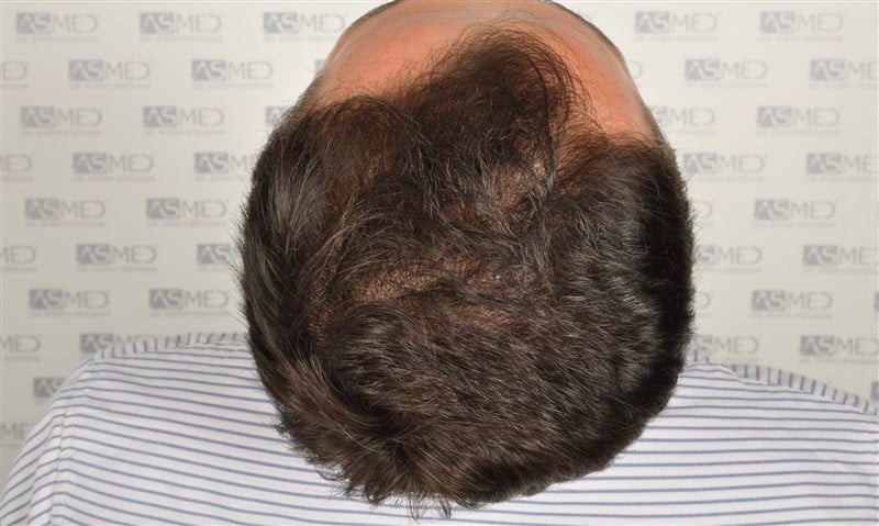 Before and After  graft    transplant at 