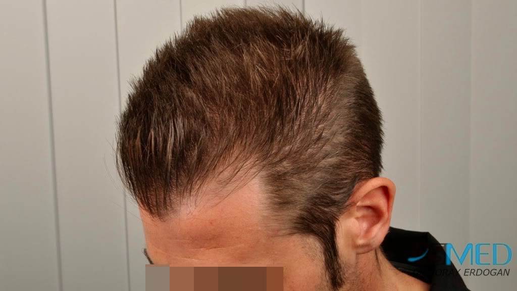 Before and After  graft    transplant at 