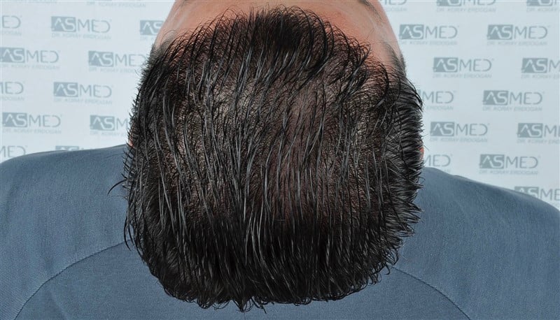 Before and After  graft    transplant at 