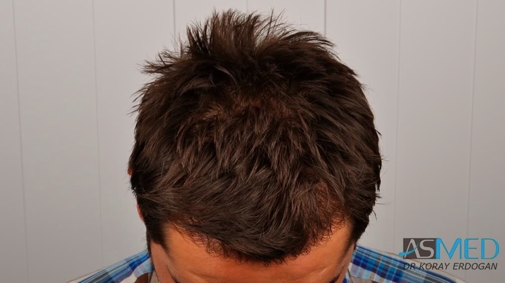 Before and After  graft    transplant at 