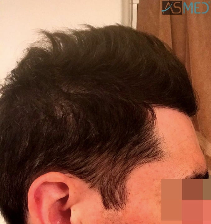 FUE Hair Transplant Result