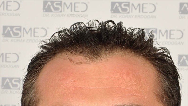 Before and After  graft    transplant at 