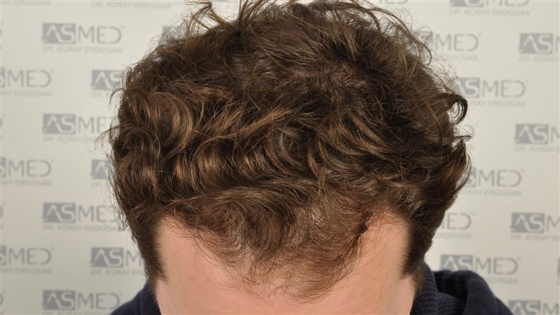 Before and After  graft    transplant at 