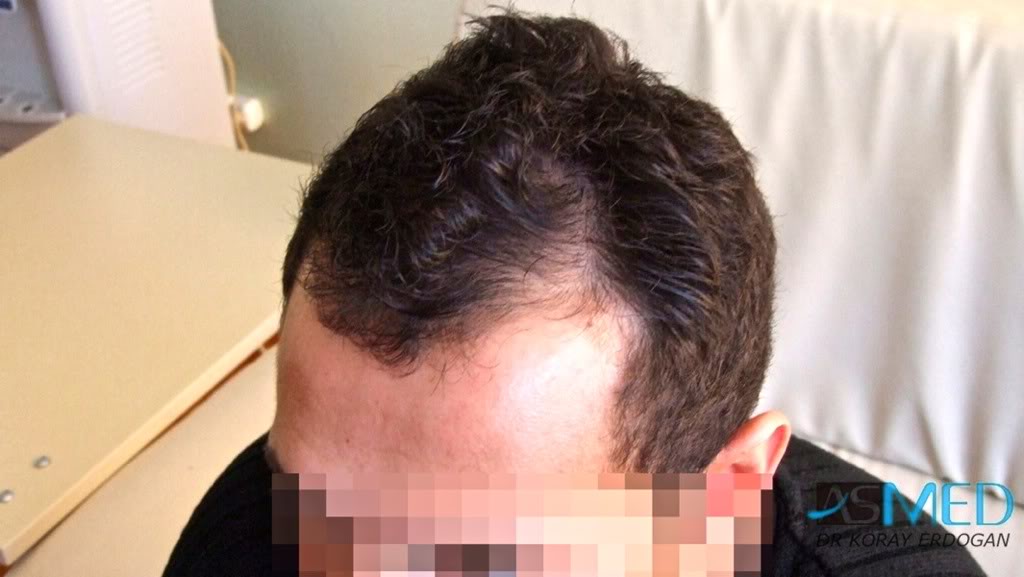 Before and After  graft    transplant at 