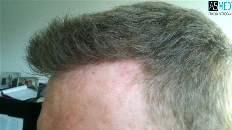 Before and After  graft    transplant at 