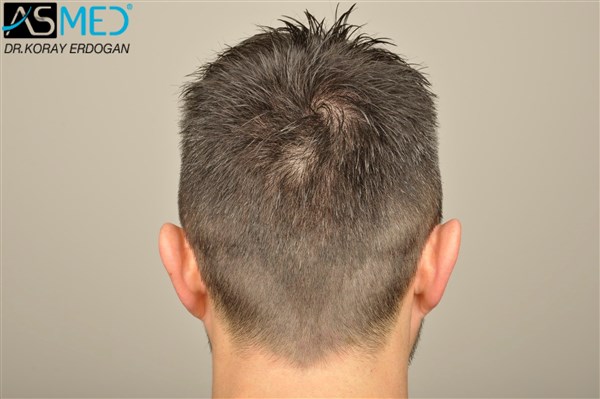 Before and After  graft    transplant at 