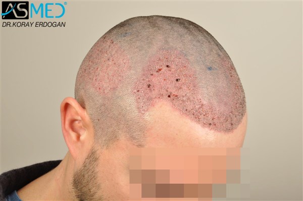 Before and After  graft    transplant at 