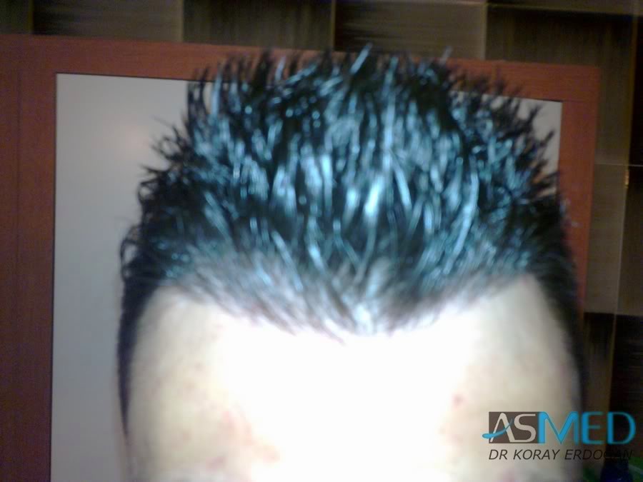 Before and After  graft    transplant at 