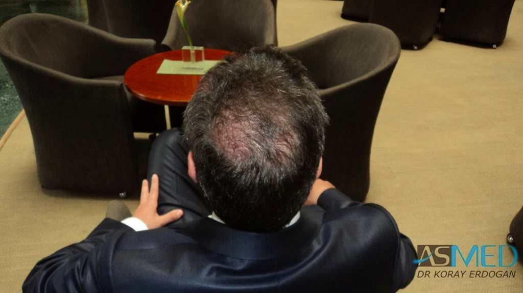 FUE Hair Transplant Result