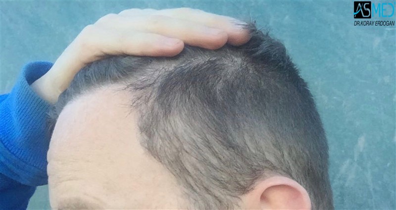 FUE Hair Transplant Result