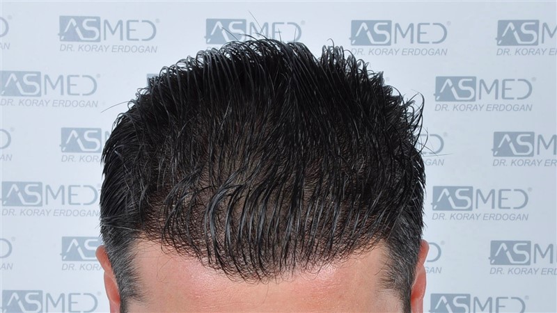 Before and After  graft    transplant at 