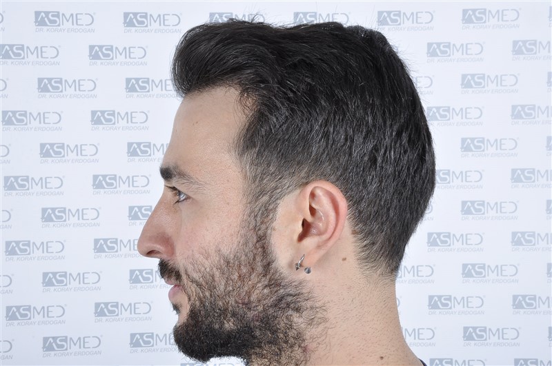 Before and After  graft    transplant at 