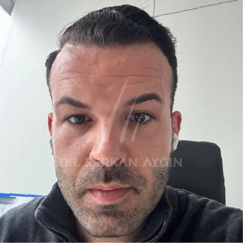 DHI Hair Transplant Result