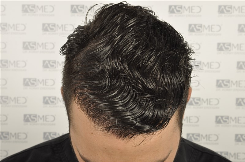 Before and After  graft    transplant at 