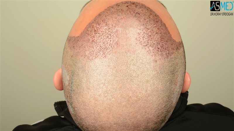 Before and After  graft    transplant at 