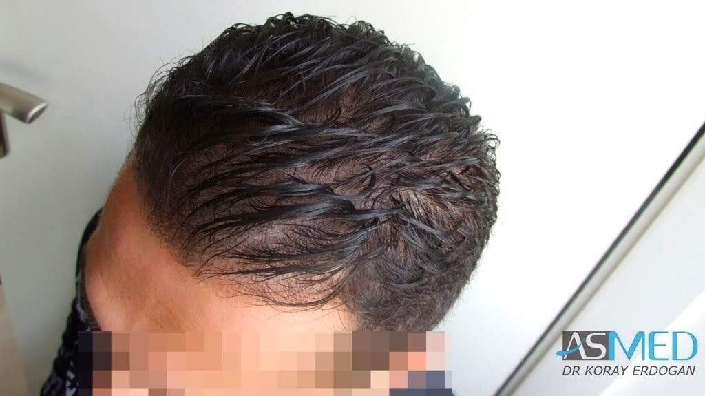 Before and After  graft    transplant at 