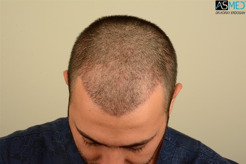 Before and After  graft    transplant at 
