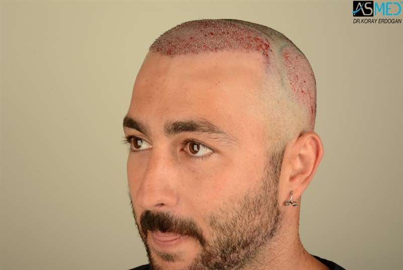 Before and After  graft    transplant at 