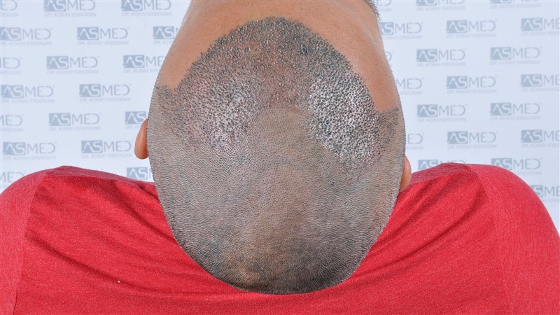 Before and After  graft    transplant at 