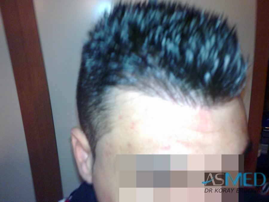 Before and After  graft    transplant at 