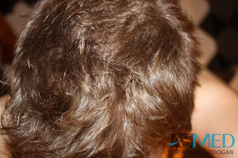 Before and After  graft    transplant at 